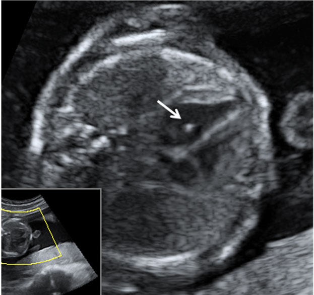 Corazón fetal con foto ecogénito en ecografía