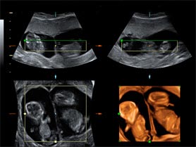 Ecografía en 2D y 3D de gemelos de 11 semanas