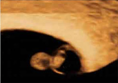 ecografia 3d embarazo 6 semanas