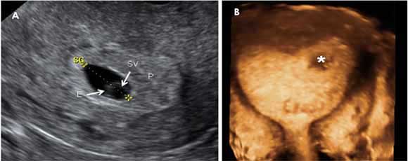 Embarazo 5,6 semanas: imagen tomada con ecografía vaginal