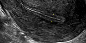 Ecografía endometrio fino