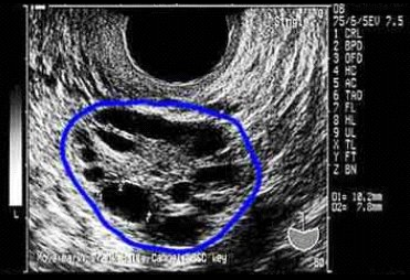 eco ovario poliquistico
