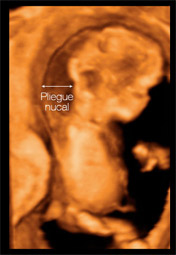 Ecografía 3D de un embarazo de 12 semanas: Pliegue nucal