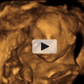 Bebé levantando brazos: ecografía semana 20