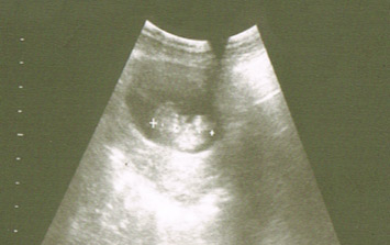 miércoles Nuez factor Embarazo semana 8: Vesícula y corazón, a la vista - Natalben