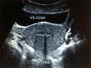 eco útero normal