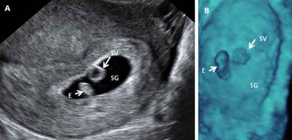 Semana 7 embrión: Tubo neural del bebé ya cerrado