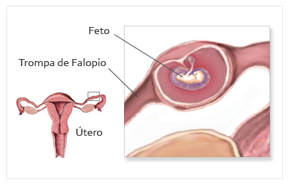 embarazo ectopico