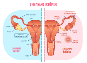 Gestación ectópica: signos y señales de alarma