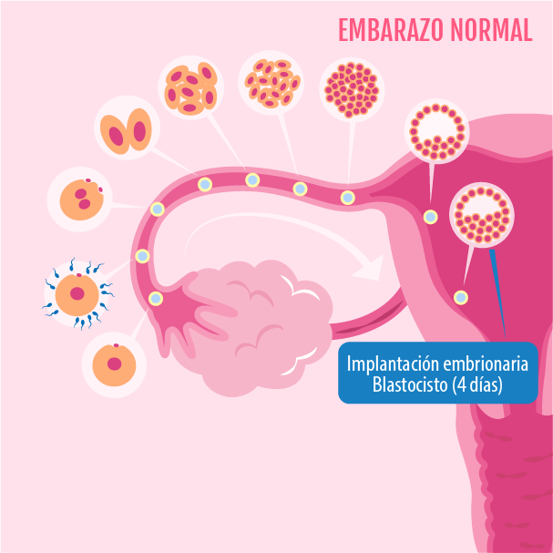 Gestación ectópica: rarezas y hechos insólitos de la mala implantación