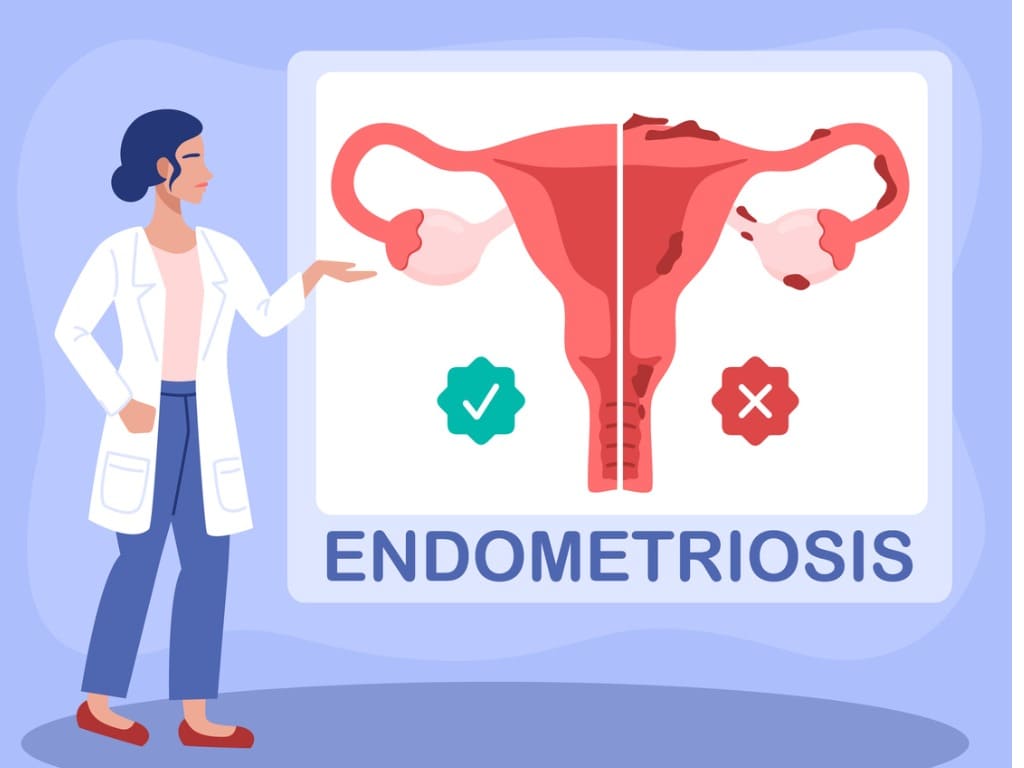 la endometriosis y la infertilidad