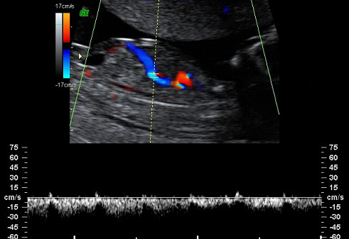 Feto 12 semanas medicion ductos venoso