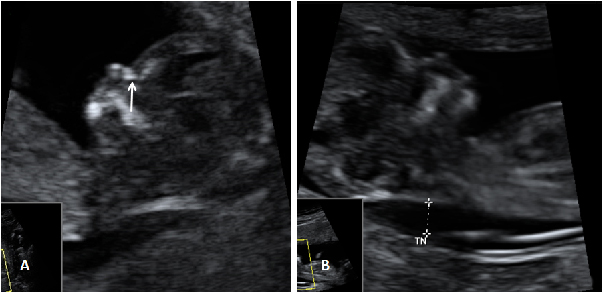 hueso nasal