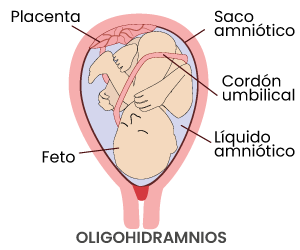 Oligohidramnios o poco líquido amniótico