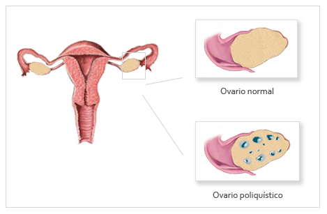 qué es el ovario poliquístico