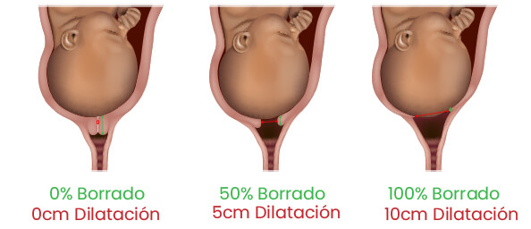 Inducción al Parto vs Evolución Espontánea a partir de las 41 Semanas de  Gestación.