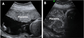 placentas primer trimestre