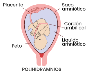 Polihidramnios o mucho líquido amniótico