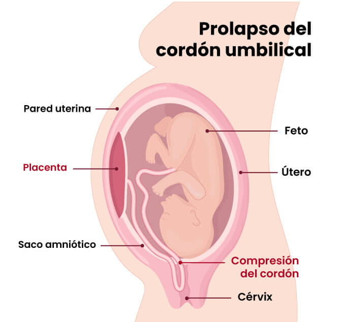 El cordón umbilical en el parto