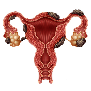 Ecografía para descartar quistes ováricos y endometriosis