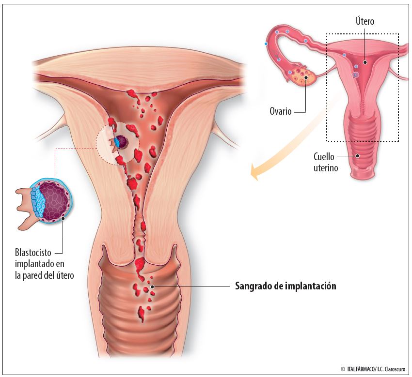 Sangrado de implantación: síntoma o señal de embarazo