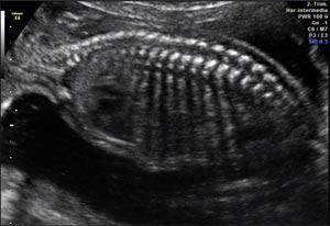 Semana 17 embarazo pruebas diagnósticas