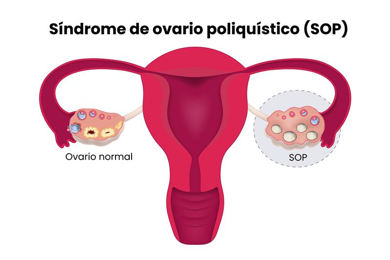 Síndrome de ovario poliquístico