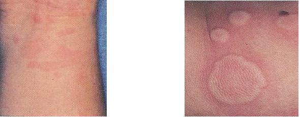 urticaria embarazo