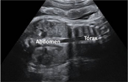 feto de 37 semanas con malformación de tórax