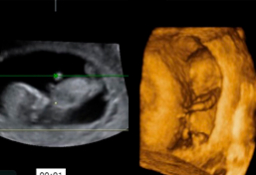 Ecografía en 2D y 3D de feto de 12 semanas
