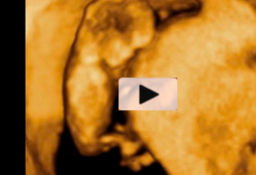 Ecografía en 4D de feto de 11 semanas, "escalando" el útero materno