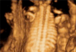Ecografía tercer trimestre - Columna y costillas de un feto