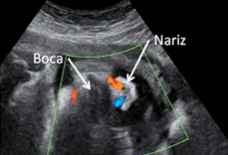 Ecografía del tercer trimestre respiración fetal