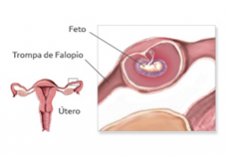 Complicaciones inducción ovulación
