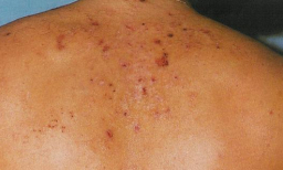 dermatitis embarazo