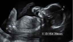 ecografías en el embarazo: 7 preguntas y respuestas