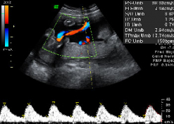 Semana 20 ecografía Doppler pulsado del cordón umbilical