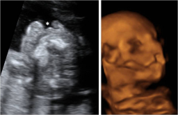 Ecografía semana 20: feto con labio leporino en 2D y 3D