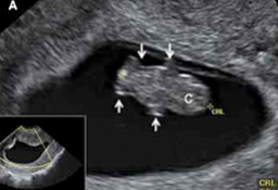 Ecografía del embrión semana 8