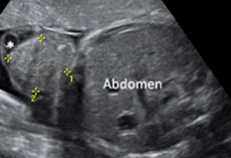 Semana 20 - Ecografía 2D del abdomen fetal con onfalocele
