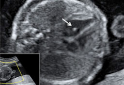 Semana 20 - Ecografía 2D Corazón fetal