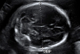 Ecorafia semana 20: medición del diámetro biparietal