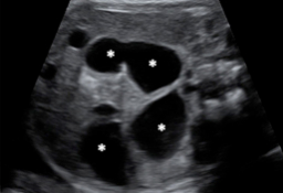 Ecografía: Obstrucción intestinal en feto de 29 semanas