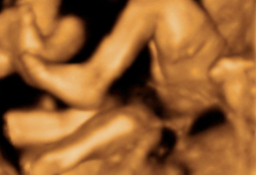 Ecografía 3D Semana 20 - Embarazo de trillizos