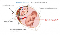 sindrome fetofetal