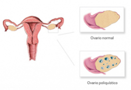 Síndrome de Ovario Poliquístico