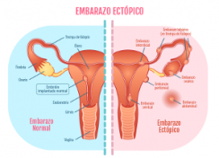 Embarazo ectópico, cosas que no sabías