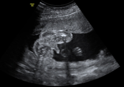 Ecografía de genitales de niño en 2D: semana 20 de embarazo