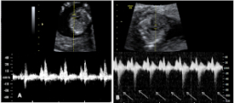 Ecografía: insuficiencia tricúspide en un bebé de la semana 12