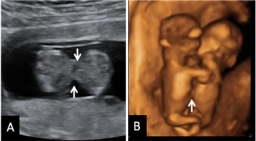 Ecografías siameses de 12 meses de gestación: unidos por el abdomen